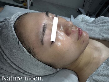 ナチュールムーン(Nature moon.)/ハーブピーリング &nbsp;after