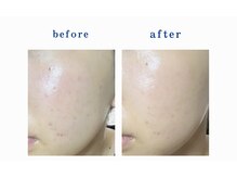 ミセル 尾道店(MYTHEL)/before after 光フェイシャル