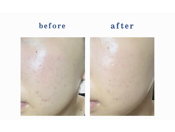 ミセル 尾道店(MYTHEL)/before after 光フェイシャル