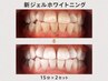 【先着10名/写真掲載OKの方】新ジェルホワイトニング15分×2セット ¥5,000