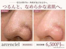 アルカンシエル(arcenciel)の雰囲気（【ニキビケアケア/シミケア/毛穴/ピーリング/ハーブピーリング】）