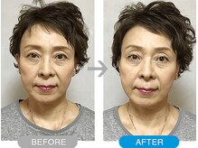 ワト(WATO)/■小顔施術（before→after)