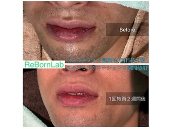 リボーンラボ(ReBorn Lab)/ヒゲ脱毛1回目BeforeAfter