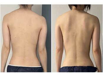 モア(moa)/ブライダルエステも!