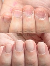 マリーロール 淀屋橋本店(Marie Laure)/自爪育成/深爪矯正/ネイルケア