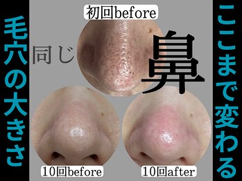 ティーツリー 名古屋 桜山(Tea Tree)/回数を重ねると毛穴も縮小します
