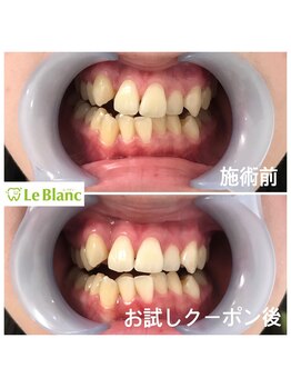ルブラン 奈良店(Le Blanc)/白い歯は得ばかり!!