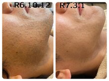 フィズ 五日市彩が丘店(FIS)/☆before/after☆髭脱毛