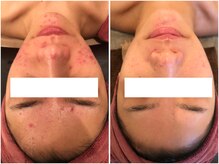 ビューティーマックス(Beauty Max)/フェイシャルbefore→after3ヶ月