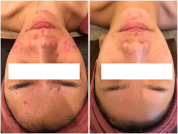 ビューティーマックス(Beauty Max)/フェイシャルbefore→after3ヶ月