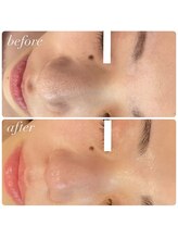 ラディエンス 多治見店/リアボーテ毛穴ケアエステ