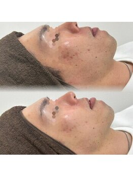 プラシア 広島駅(Purasia.)/メンズ 男性 肌管理