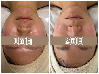 オン 絹(on silk)/小顔筋膜110分/2回施術