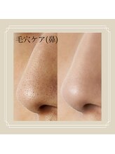 望月整体院/毛穴ケア（鼻）