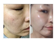 リュミエール(umiere)/オーナー吉田の肌変化