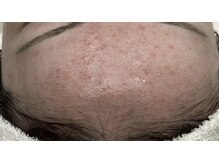 ビューティーサロン アンド ユー シブヤ(Beauty Salon&U Shibuya)/クリスティーナ施術前