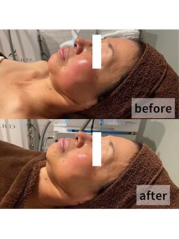 セイリキ(SEIRIKI)/光フェイシャル