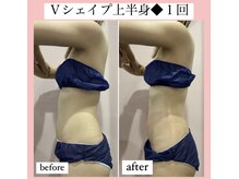 ルピナス ヒサヤ(LUPINUS hisaya)/Vシェイプ痩身