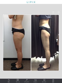 健康痩身研究所 蟹江店/ビフォーアフター