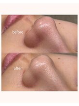 レア(Lea)/産毛と詰まり、同時除去＊