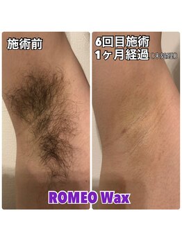 ロミオワックス 渋谷店(ROMEO Wax)/メンズ脇光脱毛☆ビフォーアフタ