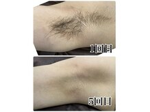エース 赤坂の雰囲気（この夏人気のわき脱毛！汗をかきやすいので蒸れや臭いを軽減！）