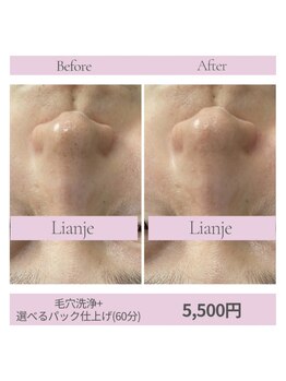リアンジェ(Lianje)/ハイドラ毛穴洗浄+パック仕上げ