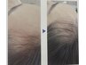 EVOCAIR成長毛髪ケアコース★ ヘアライン★頭部★ ¥43,940 