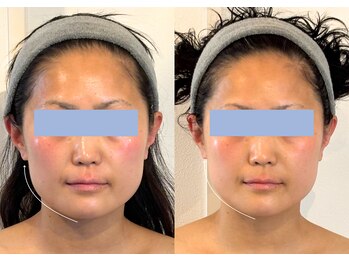 ステラ(STELLA)/エラ張り/小顔/ほうれい線撃退