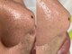 サンビューティー 心斎橋(SAN Beauty)の写真/【進化型プラズマ機リブセラ】悩みに合わせオーダーメイドフェイシャルが可能☆[毛穴洗浄/顔脱毛/眉毛ケア]