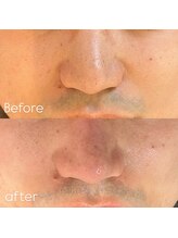 メンズエムボーテ 太田店(Men's M BEAUTE33)/【全顔毛穴洗浄】