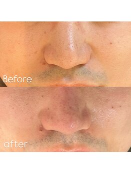 メンズエムボーテ 太田店(Men's M BEAUTE33)/【全顔毛穴洗浄】