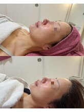 GRACETHOUSAND(グレイスサウザンド)/乾燥/酒さ/赤ら顔/敏感肌/乾燥