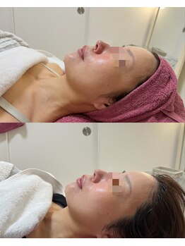 GRACETHOUSAND(グレイスサウザンド)/乾燥/酒さ/赤ら顔/敏感肌/乾燥