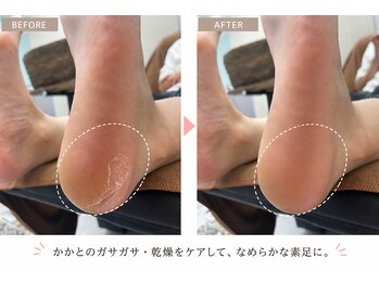 ネイル ラナ(lana)の写真/【今がベスト】夏前の角質ケアで差がつく足元へ☆