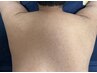 【硬毛化したムダ毛に悩む方へ】背中(うなじ+背中上部) wax脱毛 ¥5,500