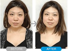 ワト(WATO)/■小顔施術（before→after)
