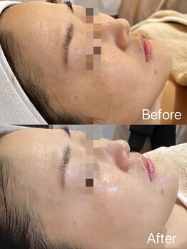 リングケー(Ling K)/白玉肌フェイシャルエステ