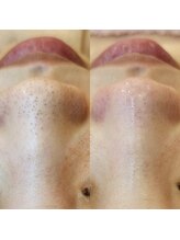 レイネイル レイエステティック 岐阜茜部店(RAY NAIL & RAY ESTHETIC)/U24学割"新"毛穴角栓洗浄