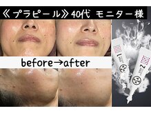 サロンスペース/水光肌【プラピール】モニター様