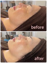 サニー(SUNNY)/フォト小顔フェイシャルコース