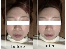 ダイアリー(DIARY)/小顔矯正