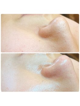 ピエル 柏店(PIEL)の写真/【自然の力で美肌へ導く】クリスティーナハーブピーリングでシミやくすみを改善◎お肌の変化を実感♪[柏]