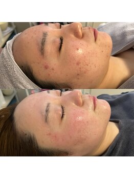 リリアス(RILLIAS)/ニキビケア