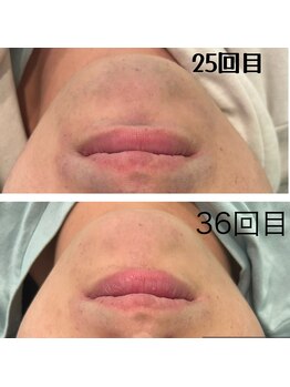 レイモード(Ray mode)/髭脱爆抜けメニュー