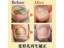 巻き爪補正店 北千住店の雰囲気（巻き爪・陥入爪・分厚く変形した変形爪でお悩みの方へ［変形爪］）