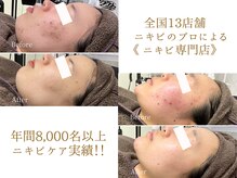 ニキビケア研究所 横浜店/年間8000名以上のニキビ改善！