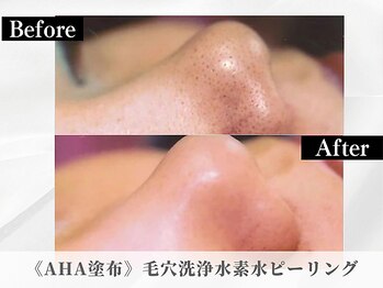 ポーベルポー(Peau Belle poe)/AHA高濃度水素毛穴ピーリング