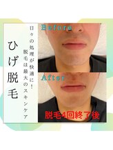 ソラ(SORA)/ヒゲ脱毛4回終了後