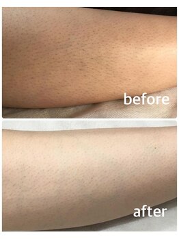 アネモネ(anemone)/ひざ下変身